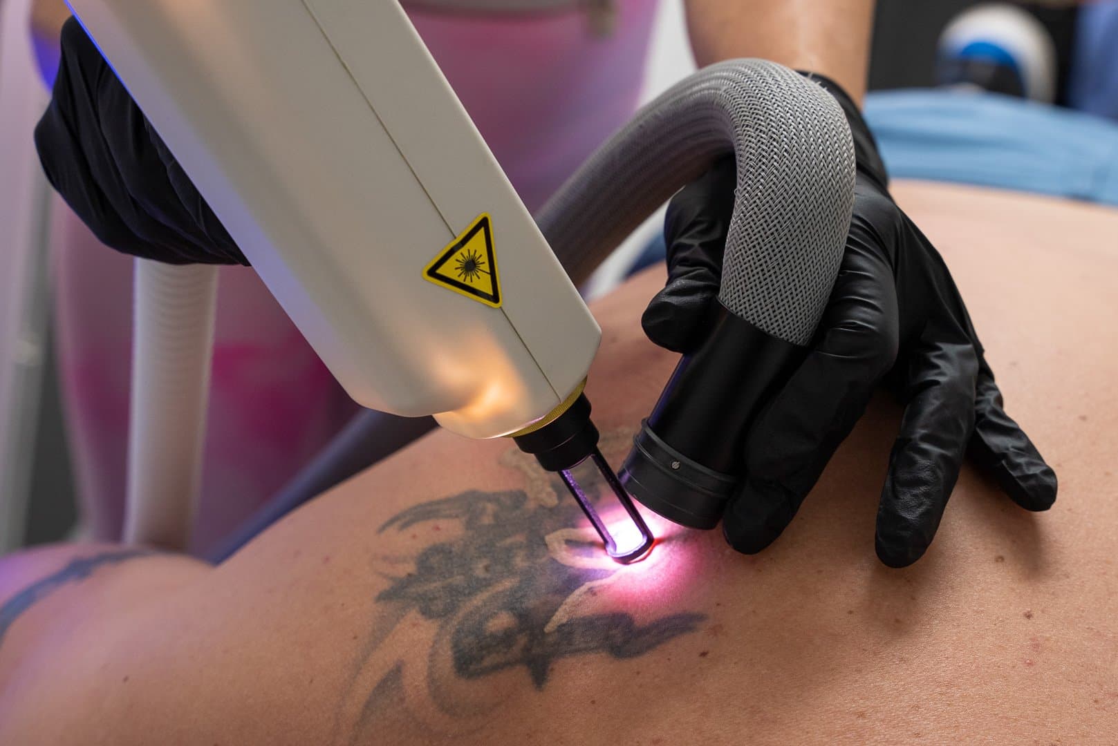 Laser tattoo removal training session inside clinic environment