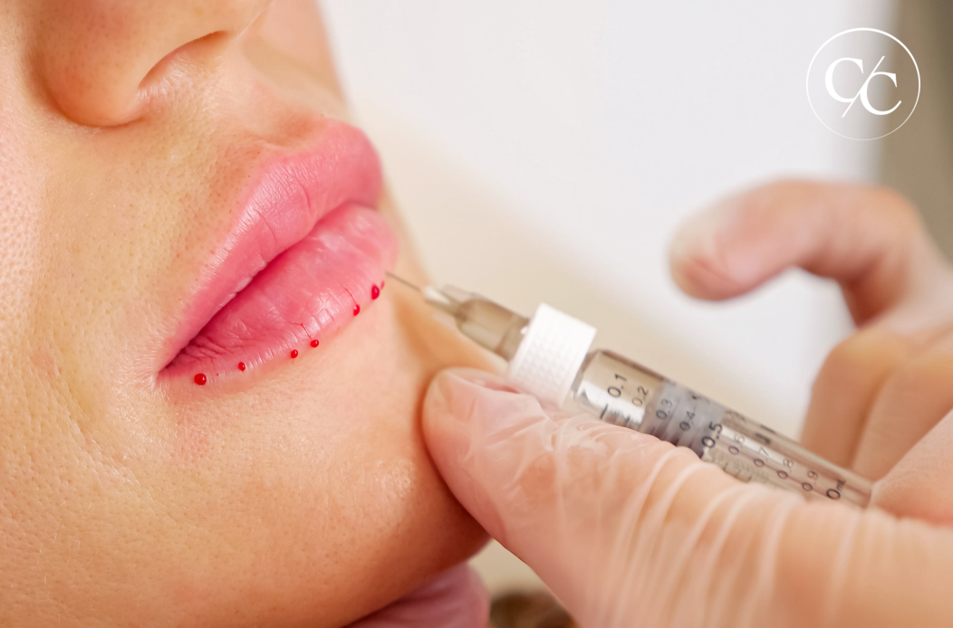 Lip filler model treatment