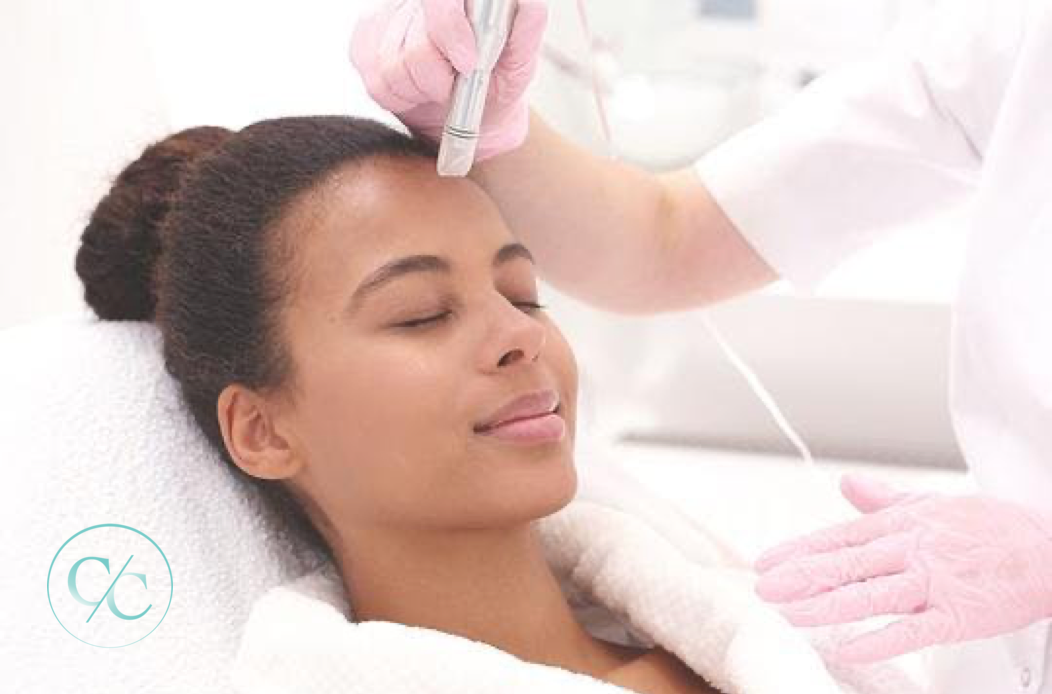 Microneedling model treatment