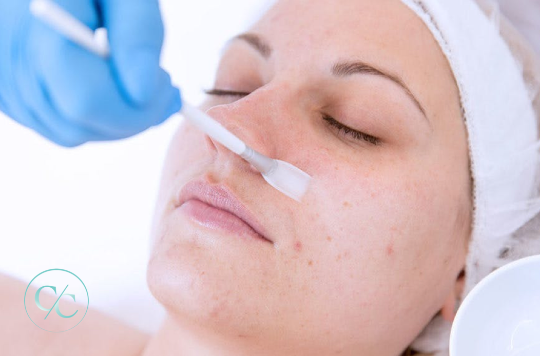 Chemical peel model treatment